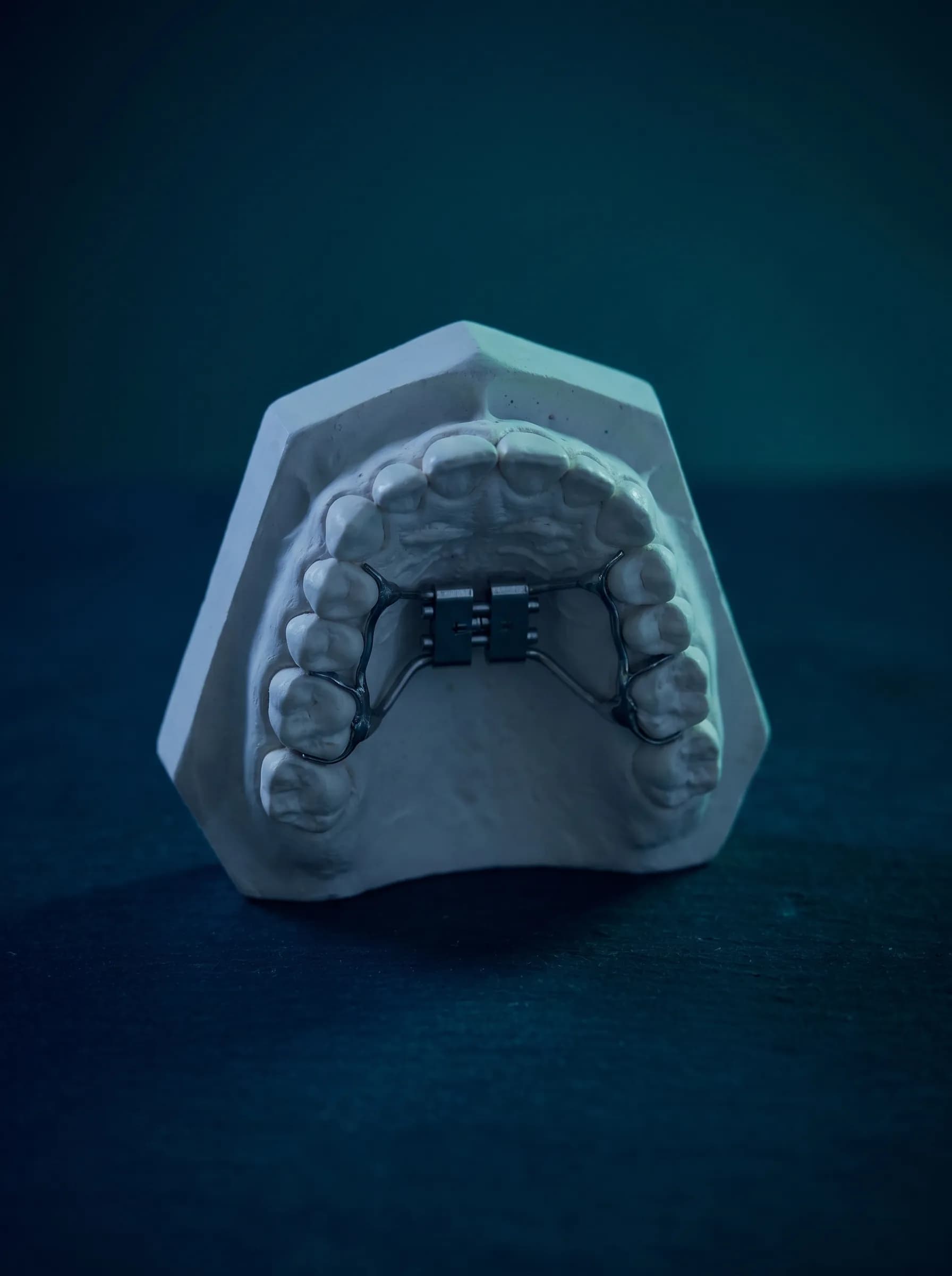 Palatal expander on a mixed dentition study model