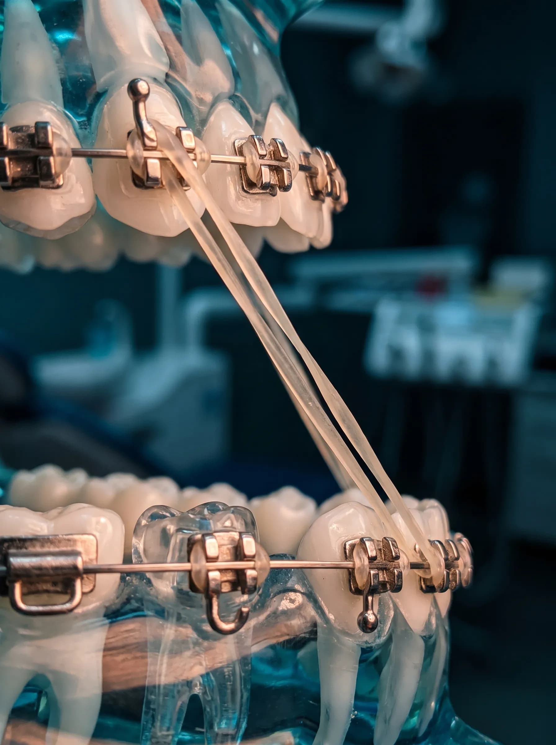 Class II intermaxillary elastic stretched between upper canine and lower molar hooks