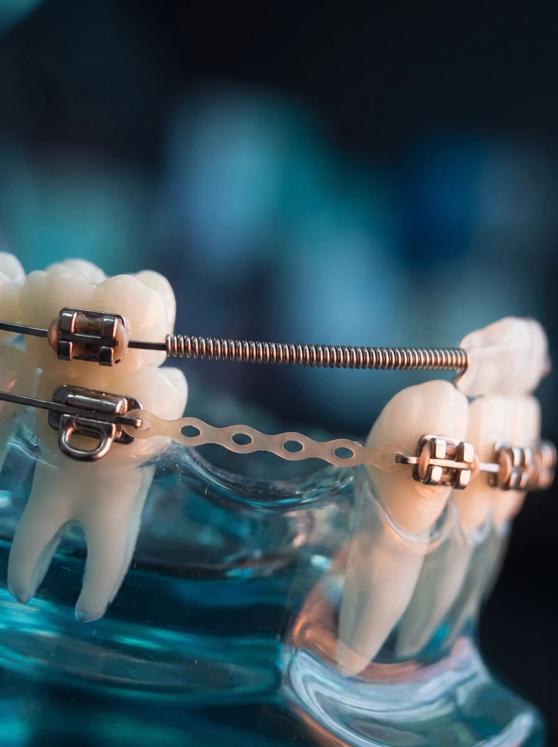 Extraction space closure with power chain and coil spring on a study model