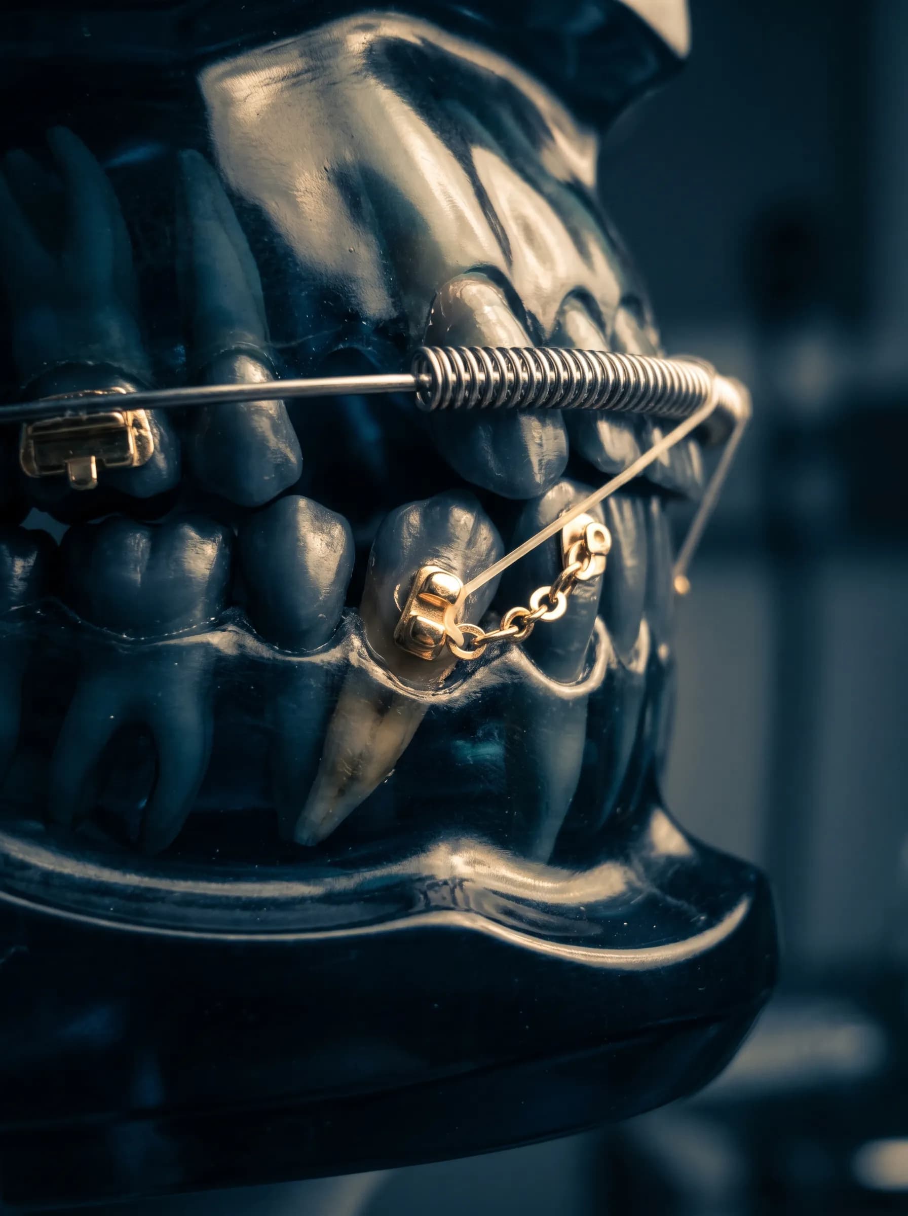 Impacted canine in bone with a gold button and traction chain pulled by a coil spring