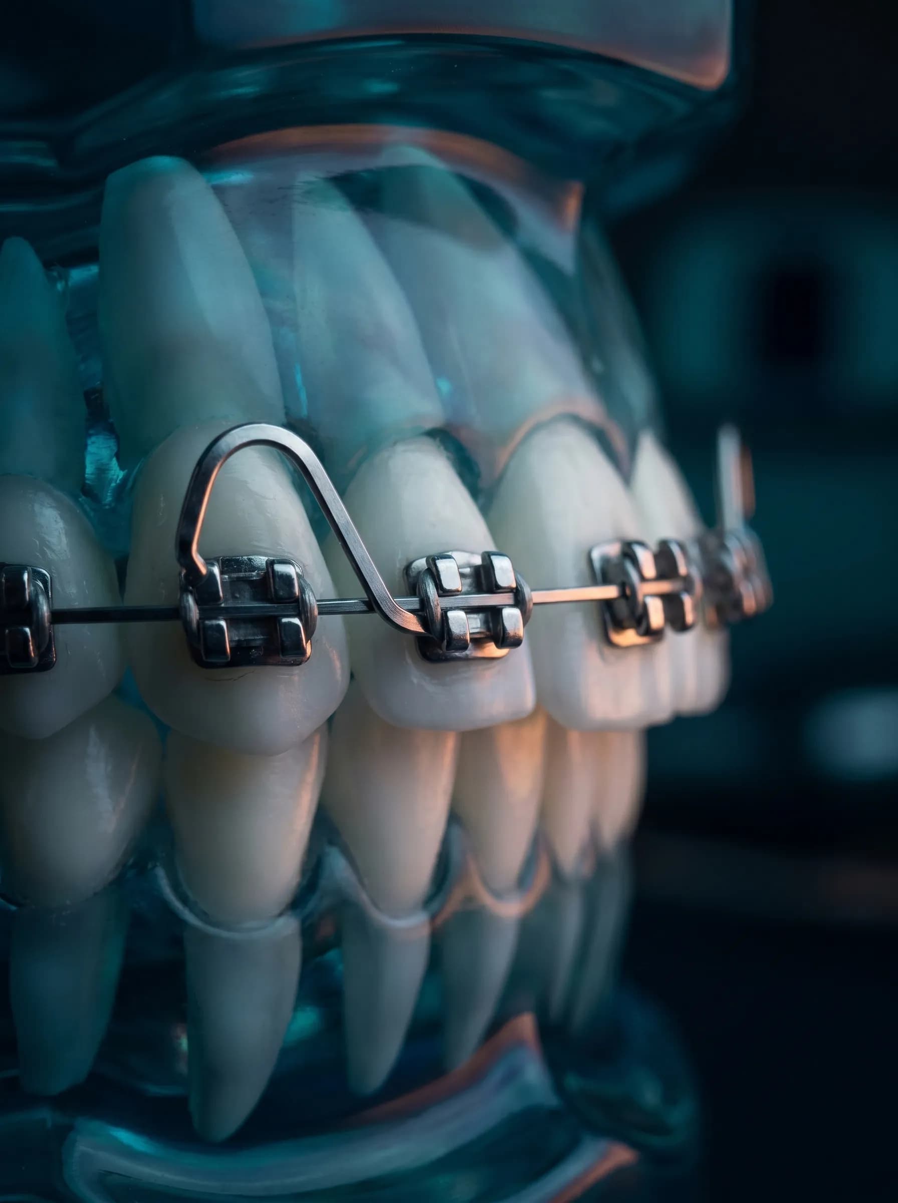 Rectangular archwire torque in bracket slots — clinical macro