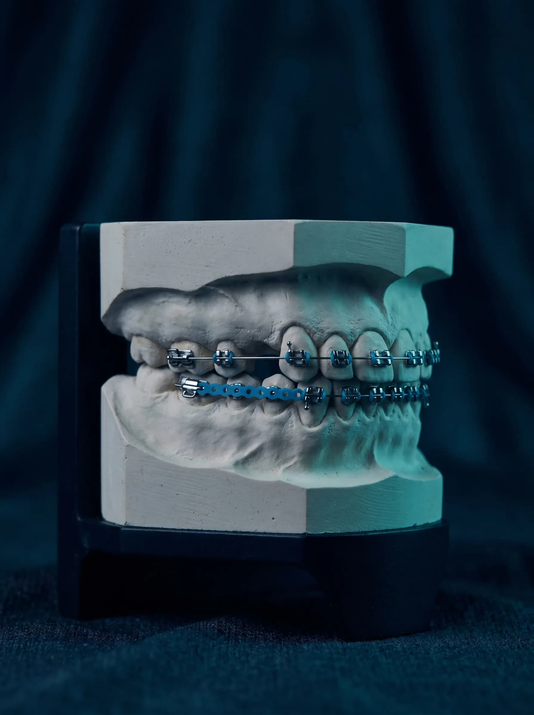 Extraction space closure with power chain on a study model