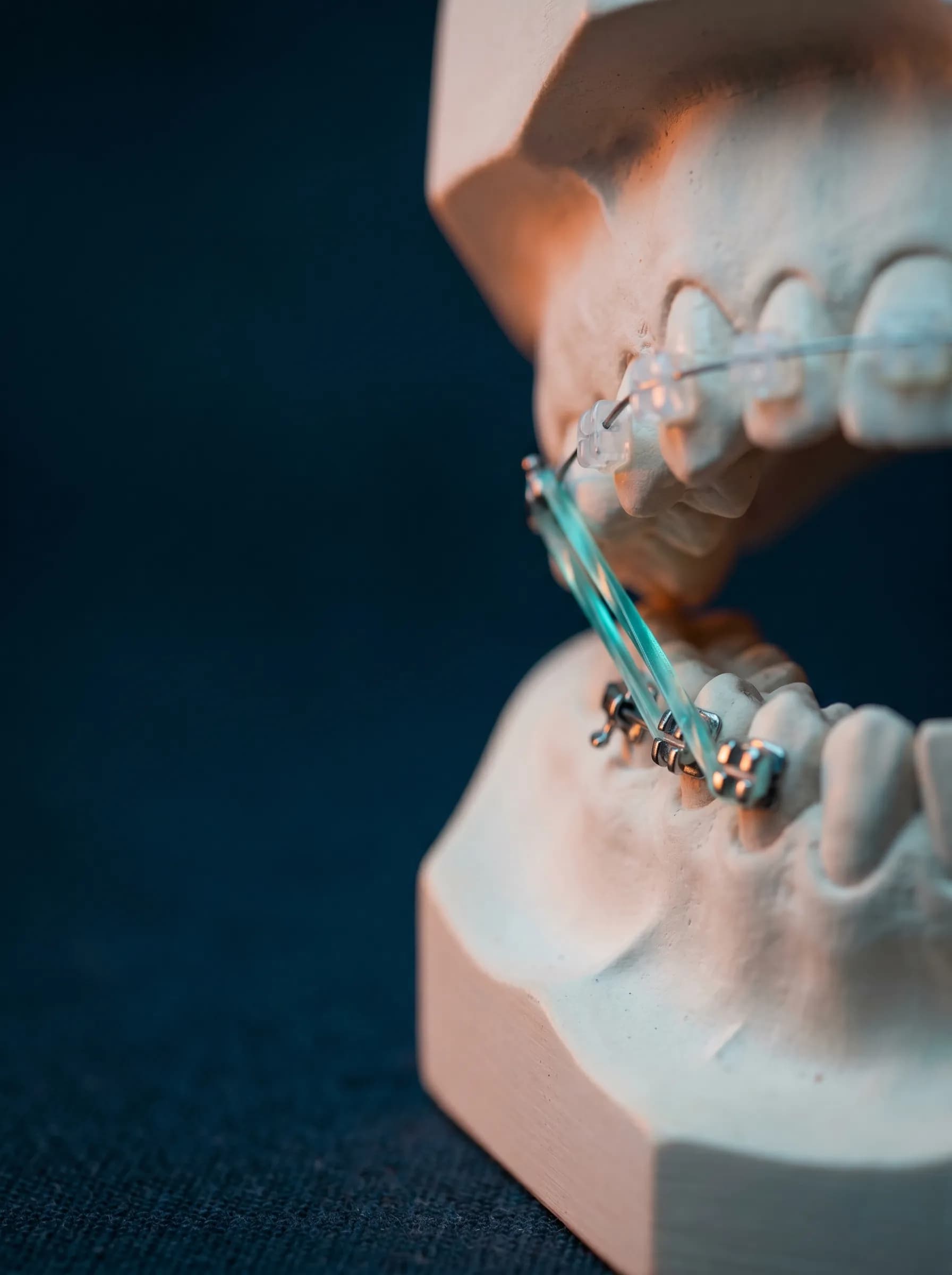 Intermaxillary orthodontic elastics on a study model
