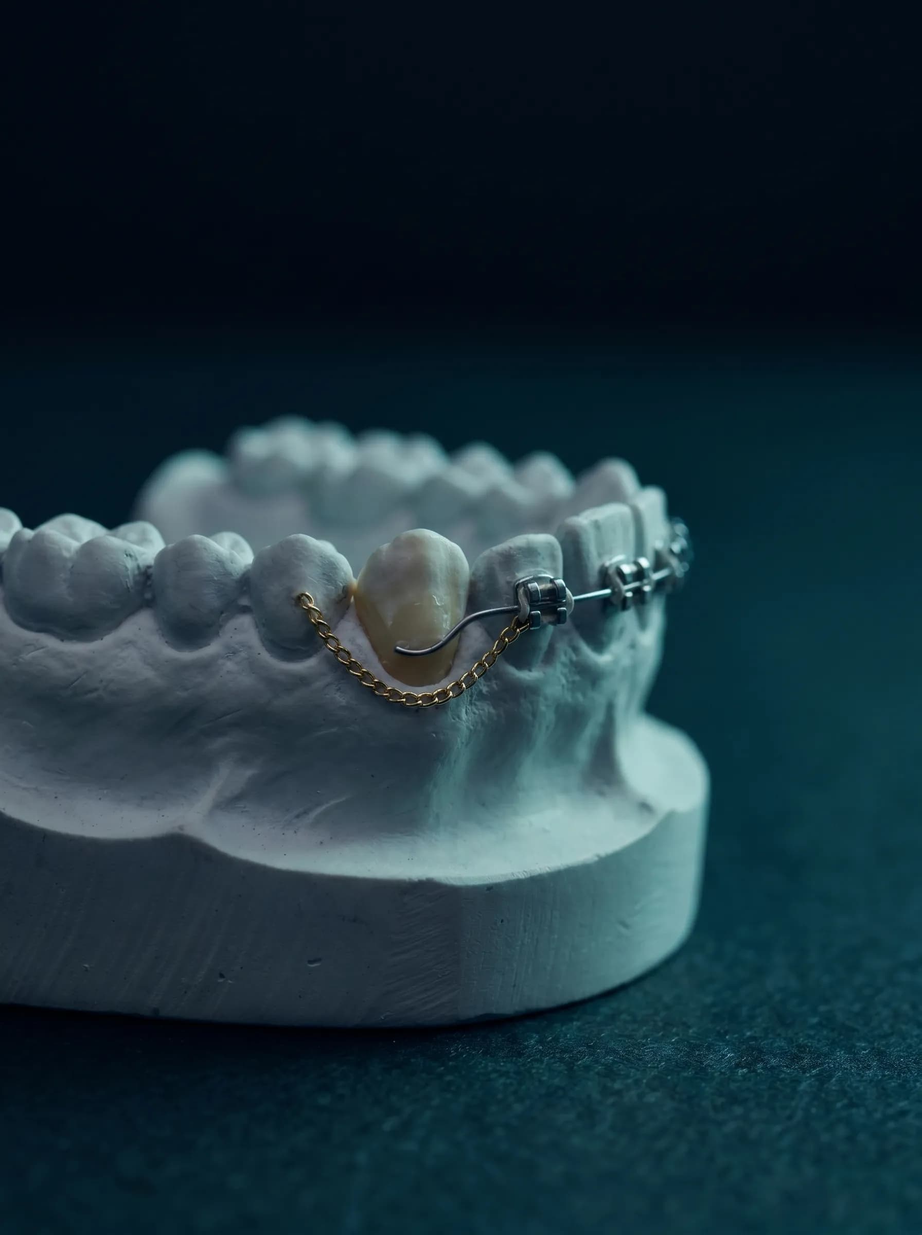 Impacted canine with gold traction chain on a study model